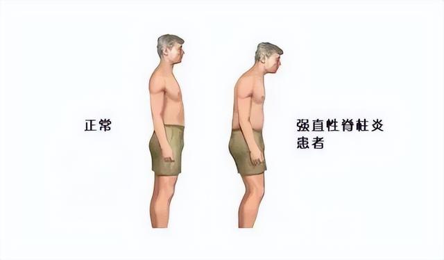 身价上亿有什么用？39岁患“不死癌症”的李宇春，给所有人提个醒