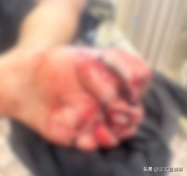 10藏民抬驴友下山收6万后续！驴友伤情曝光，网友：花钱买命 值了