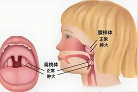 儿童的扁桃体、腺样体到底切不切？来听听耳鼻咽喉科医生的讲解...图片