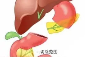 普外手术“天花板”！腹腔镜胰十二指肠切除术成功分离“隐藏”肿瘤图片