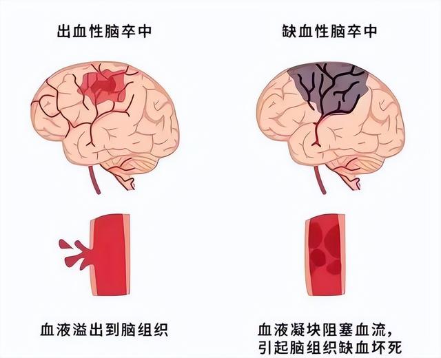 加速脑梗塞的原因：喝酒仅排第3，排第1的，很多老人都在做
