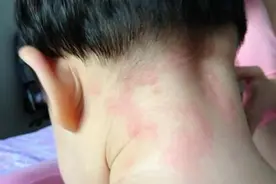 孩子过敏，有哪些特殊表现？别不放心上！一定要留意！图片