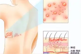 带状疱疹特效秘药图片