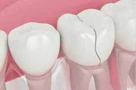 补过的牙齿劈裂了，还有救吗？图片