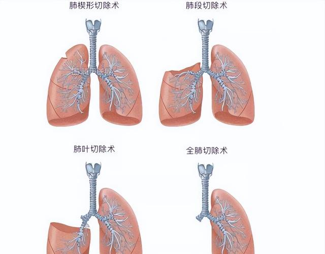 医生劝告：一旦切除肺叶，这3种运动就别做了！别害苦自己