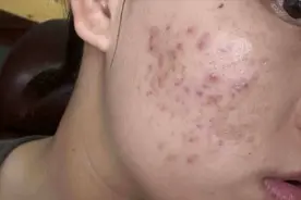 每天几毛钱就能搞定顽固痤疮！治愈者曝光自用妙招，有手就会！图片