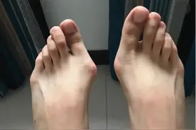 引起脚拇趾倾斜4种原因，你想知道的都在这里！图片
