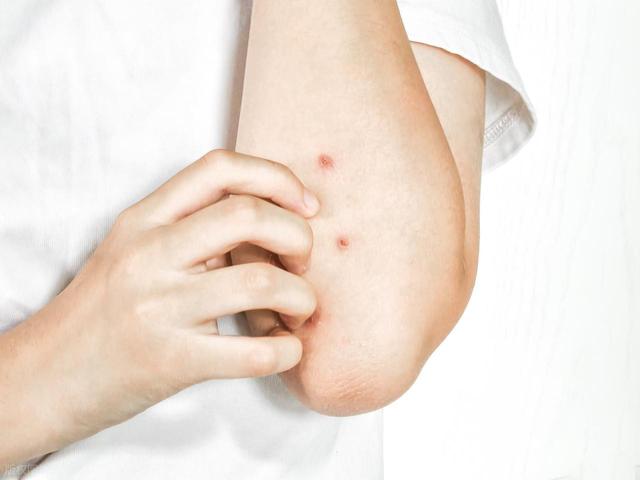 只要记住这3个关键点，湿疹很快就好了，皮肤慢慢变干净！