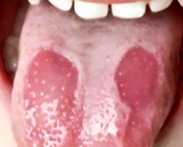 自闭症孩子聪明着呢！三味药配好，把气“撒”出去，孩子就通透了
