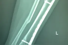胫腓骨骨折手术后一年了，又要准备去取钢板了图片
