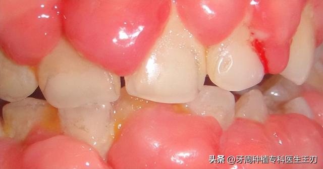 牙龈增生的原因和治疗方法