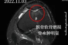 关节不好，补氨糖到底有没有用？什么时候补？补多少？医生告诉您图片