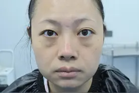 36岁一时冲动把眼袋手术做了，术后长这样，揭秘手术过程给大家图片