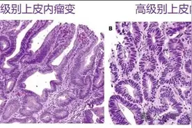 HPV感染，这些情况赶紧去做活检！别拖，小心出大事儿图片