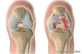 什么是膝骨关节炎？医生介绍病因、症状、诊断和治疗四个方面图片