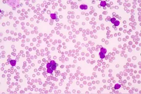 滤泡性淋巴癌患者，化疗坚持不下去，采用新型靶向药配合中药疗法图片