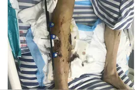 男子骑车意外受伤，面临截肢风险！幸亏他们妙手回春！图片