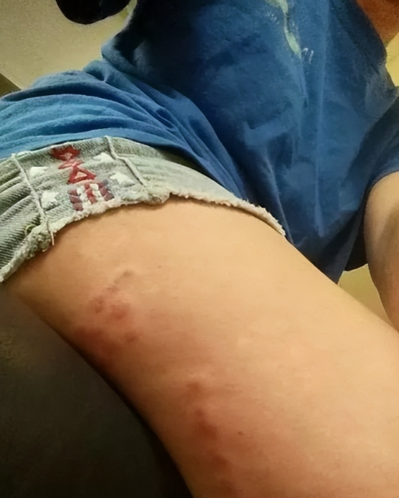 美国爆发新型疾病，传播速度快症状致命，我国暂未输入但须警惕！