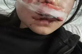 女孩称跨年夜有人朝人群扔“战神鞭炮”，自己面部被炸缝20多针，希望征集现场视频寻找肇事者图片