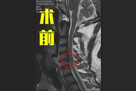 大拇指、胳膊出现疼痛、麻木，可能是这个节段的颈神经受压了！图片