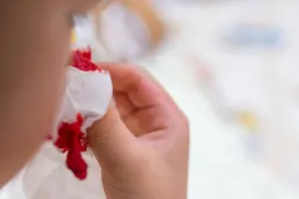6岁孩子频繁流鼻血，空气越干燥越严重，还好只是鼻腔问题图片