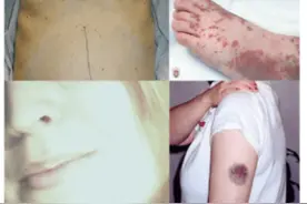 再生障碍性贫血，刘教授两方子交替使用，服药三个月恢复正常工作图片