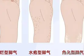 脚气总反复？你踩了哪些“坑”？避开它们，正确用药是关键！图片