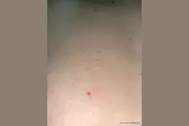洗澡的时候发现身上长了几个红点，不知道啥毛病，心里有点慌。图片