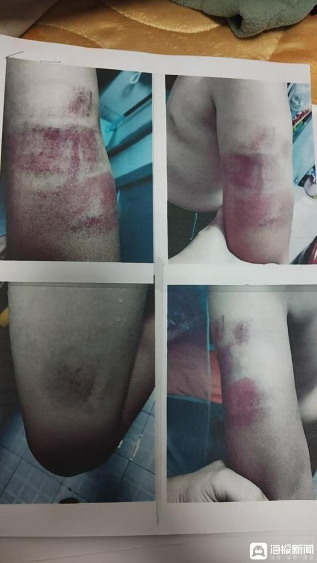 福建厦门一小学生因作业丢失 被老师打致轻微伤 律师：家长可以要求老师赔偿