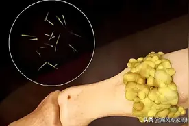 尿酸下降，痛风更厉害？因你降得太快！痛风专家周桂兰揭秘！图片