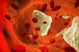 药物不能消除动脉斑块，但是可以逆转，要如何做？图片