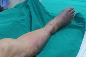 人有没有血栓，散步知道？提醒：体内有血栓的人，散步常有4表现图片