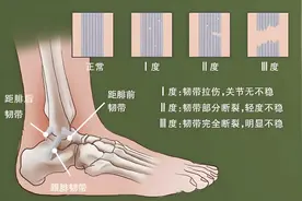 布骨康复医学科普：崴脚两个月后怎么还是疼，怎么回事呀图片