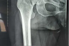 老人摔倒后导致股骨颈骨折，是保守还是手术？图片