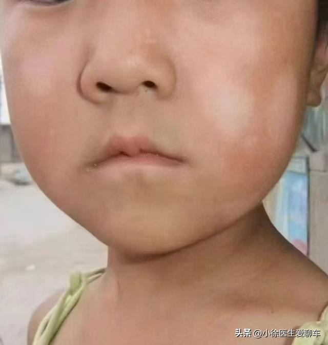 白色糠疹频发难消，商家鼓吹营养素，正确护理竟是如此简单!