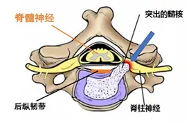 神经根型颈椎病的中药治疗方法图片