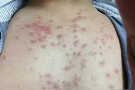 毛囊炎，一种“闷”出来的皮肤病,图片