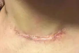 疤痕增生凸起，不要怕，看这一篇就明白了！图片