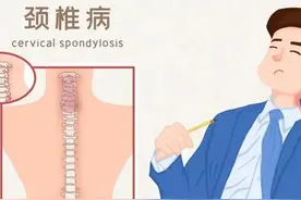 脖子酸、肩膀疼？治疗颈椎病，中医有妙招图片
