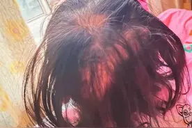 湖南3岁女童铊中毒，眼神呆滞，无法正常行走，大把掉头发图片