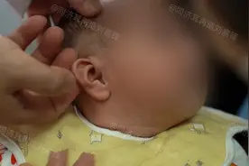 宝宝部分耳朵埋进头皮里有什么影响？这个你一定想不到！图片