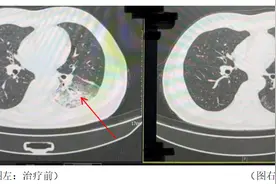 吹了3天空调，成都一男子左肺“白”了一半！专家紧急提醒图片