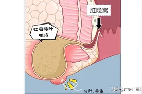 肛周脓肿硬块怎么消掉?？？图片