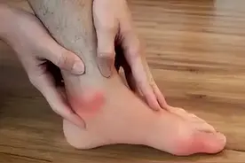 脚痛风急发作了先别慌，三个诀窍帮你快速缓解疼痛，不学亏大了图片