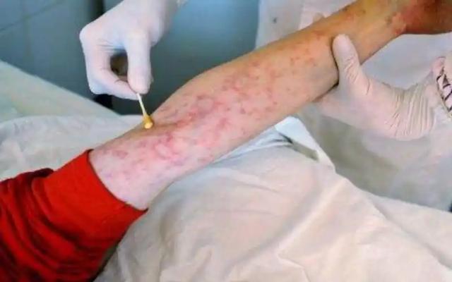 女人若是感染了“艾滋病”，胳膊上或有4种症状，都以为是皮肤病