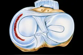 膝盖咔咔响要警惕！4 种损伤预警！这种声音最危险图片