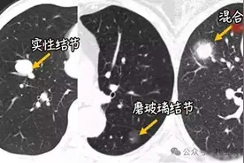 这3种磨玻璃肺结节可能是肺癌，另外这些则是炎症，不必担心！图片
