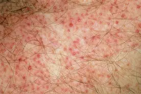 毛囊炎反复发作很烦人？你得先了解这4大诱因，对症解决很关键图片