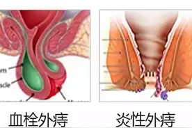 十人九痔，但这三种痔疮要做手术图片