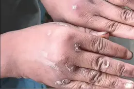 紧急！缅甸腊戌、当阳山区村庄儿童皮肤病肆虐图片